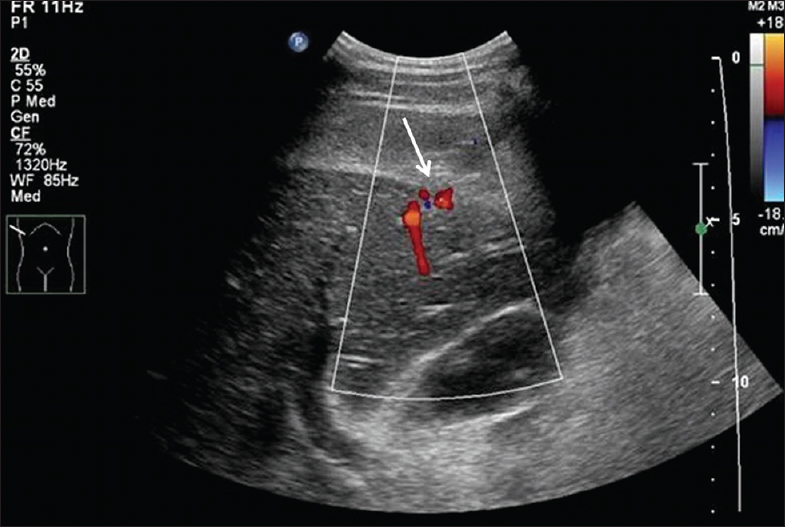 Gray scale sagittal ultrasound image of liver with color flow Doppler demonstrates active bleeding from the segment 5 of liver corresponding to the biopsy site (arrow).