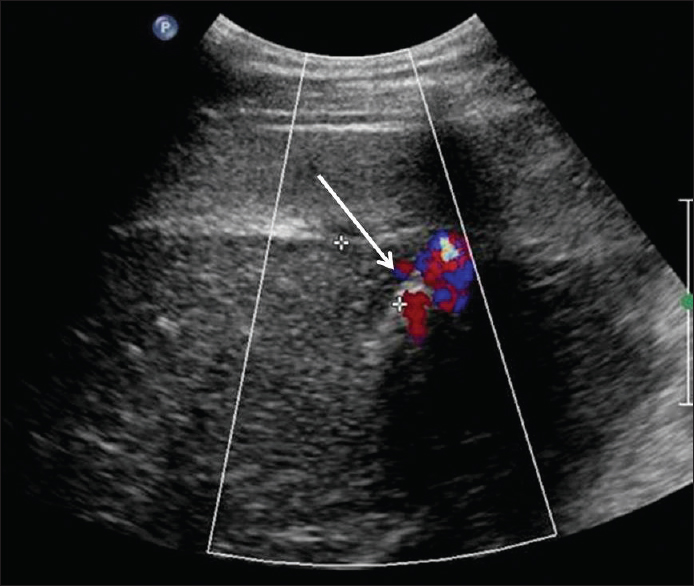 Ultrasound-guided percutaneous microwave ablation performed with microwave needle targeted at the bleeding zone at segment 5 of the liver (arrow) demonstrates post ablation changes with cessation of bleeding.