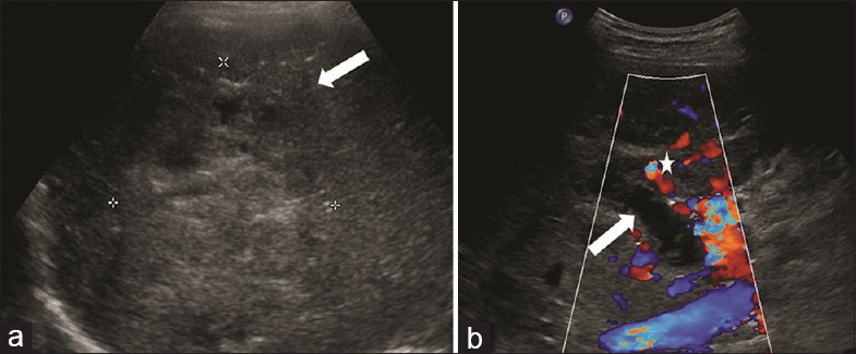 A 47-year-old male presenting with a 3-month history of fever, rigors, and weight loss was diagnosed with pylephlebitis and hepatic abscess secondary to chronic appendicitis. Transverse ultrasound images of the right hepatic lobe demonstrate (a) an ill-defined mixed echogenic lesion (arrows) with few small cystic foci, and (b) a distended portal vein with no flow on color Doppler consistent with portal vein thrombosis (arrow). There are also associated small periportal collaterals consistent with cavernous transformation (asterisks).