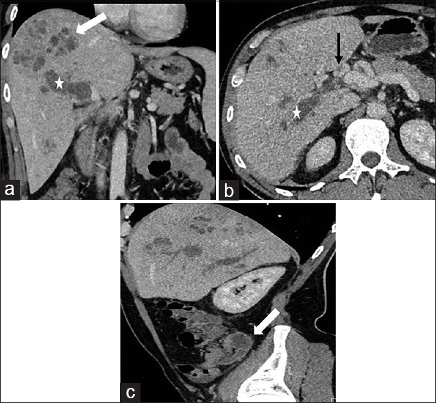 A 47-year-old male presenting with a 3-month history of fever, rigors, and weight loss was diagnosed with pylephlebitis and hepatic abscess secondary to chronic appendicitis. (a) Coronal, (b) axial, and (c) sagittal contrast-enhanced computed tomography images of the abdomen. (a and b) Show occlusion of the intra-hepatic portal vein with expansile hypodense material (asterisks) consistent with pylephlebitis, periportal collaterals (black arrow) consistent with cavernous transformation and an ill-defined pyogenic abscess (white arrow) with a “clustered” appearance, (c) demonstrates a dilated appendix (white arrow) with only minimal wall irregularity in the right lower quadrant as well as pylephlebitis (asterisks) within the liver.