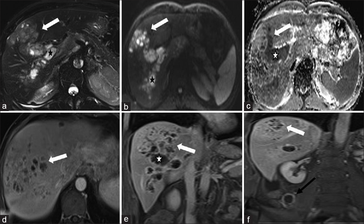 A 47-year-old male presenting with 3 months history of fever, rigors, and weight loss was diagnosed with pylephlebitis and hepatic abscess secondary to chronic appendicitis. (a) Axial T2-weighted fat-suppressed magnetic resonance image: Expansion and occlusion of intra-hepatic portal vein by heterogeneous T2 hyperintense material - pylephlebitis (asterisk) which is contiguous with hepatic abscess (arrow), (b and c) axial diffusion-weighted magnetic resonance and apparent diffusion coefficient map: Restricted diffusion in pylephlebitis and hepatic abscess, (d) axial, and (e) coronal gadolinium-enhanced T1-weighted images: Hepatic abscess and pylephlebitis share a peripheral enhancement pattern with foci of linear internal vascularity, (f) coronal enhanced T1-weighted image shows a dilated appendix (black arrow) with mural hypervascularity.