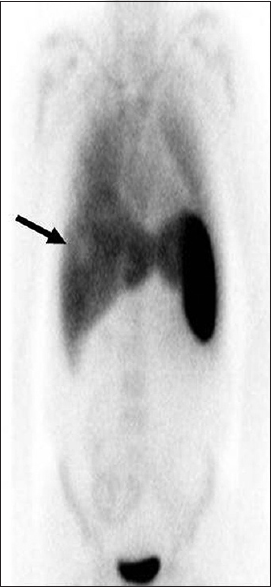 A 47-year-old male presenting with a 3 months history of fever, rigors and weight loss was diagnosed with pylephlebitis and hepatic abscess secondary to chronic appendicitis. On the nuclear medicine white cell study with whole body coronal images performed at 24 h, a focus of photopenia (arrow) within the right lobe of the liver is noted corresponding to the hepatic abscess. No abnormal extrahepatic tracer accumulation was visualized to suggest an extrahepatic source for the sepsis.