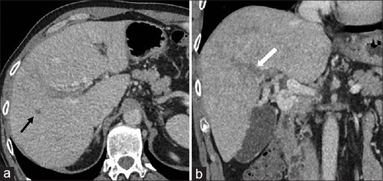 A 47-year-old male presenting with a 3-month history of fever, rigors, and weight loss was diagnosed with pylephlebitis and hepatic abscess secondary to chronic appendicitis. Axial (a) and coronal, (b) contrast-enhanced computed tomography images performed after treatment with antibiotics and anticoagulation at 6-weeks show interval improvement with a decrease in the size of the hepatic abscess (black arrow) and pylephlebitis (white arrow).