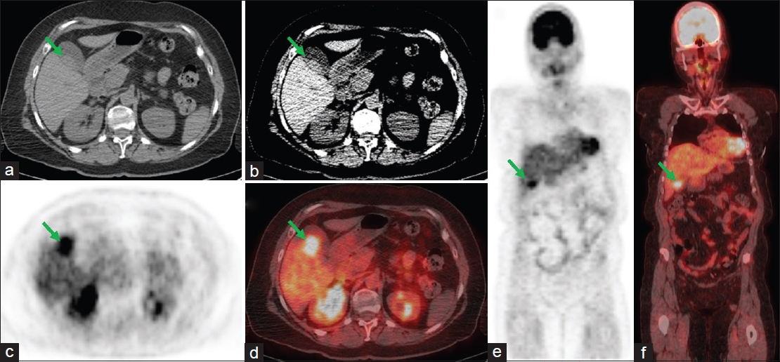 A 65-year-old female with a history of multiple myeloma status postchemotherapy, presenting for a restaging whole-body fluorine 18-fluorodeoxyglucose positron emission tomography/computed tomography scan. (a and b) Transverse computed tomography sections of the abdomen showing nodular thickening (arrows) within the posterior gallbladder wall. (c and e) Transverse and coronal fluorine 18-fluorodeoxyglucose positron emission tomography images showing intense focal hypermetabolic activity (arrows) in the region of the gallbladder. (d and f) Fused transverse and coronal positron emission tomography/computed tomography images showing the focal area of hypermetabolic activity corresponding to the nodular thickening within the posterior gallbladder wall (arrows).