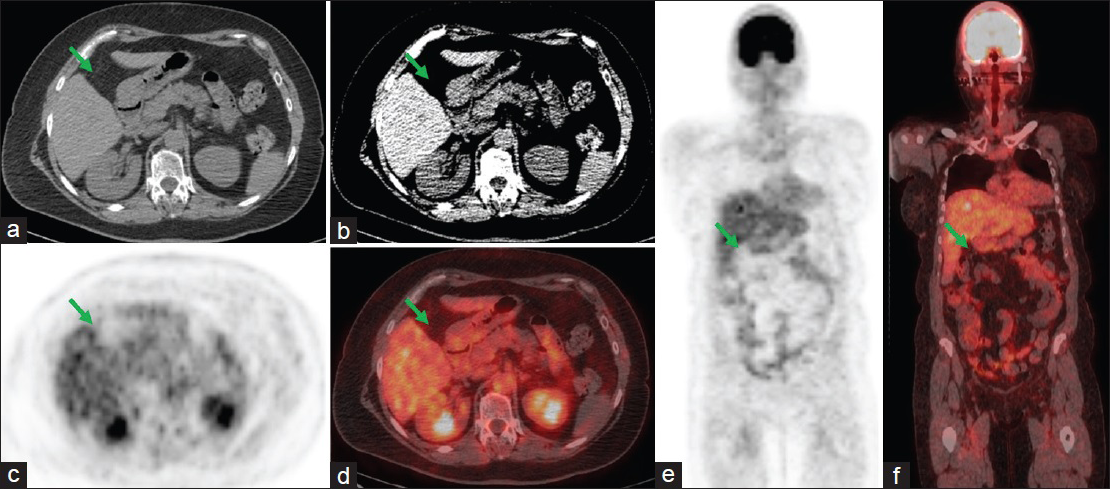 Postcholecystectomy surveillance whole-body fluorine 18-fluorodeoxyglucose positron emission tomography/computed tomography scan. (a and b) Transverse computed tomography sections of the abdomen showing postsurgical changes from cholecystectomy (arrows). (c and e) Transverse and coronal fluorine 18-fluorodeoxyglucose positron emission tomography images showing no metabolic evidence of active malignancy in the gallbladder fossa (arrows). (d and f) Fused transverse and coronal positron emission tomography/computed tomography images confirming that there is no metabolic evidence of active malignancy in the gallbladder fossa (arrows).