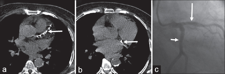 Axial plain computed tomography images in a 45-year-old male show extensive calcification in the left anterior descending (a) and left circumflex (b) indicated by arrow; catheter angiogram (c) showing normal left anterior descending (long arrow) and left circumflex (short arrow).