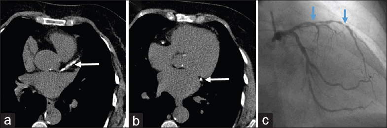 Axial plain computed tomography images in a 53-year-male show extensively calcified left anterior descending (a) and left circumflex (b) indicated by arrow; catheter angiography image (c) showing multiple foci (arrows) of insignificant and significant stenosis in left anterior descending.