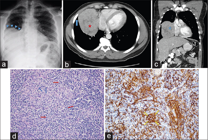 A 45-year-old otherwise healthy African man undergoing evaluation for oral thrush. (a) Posteroanterior chest radiograph shows a large mass-like density occupying the mid- and lower-right hemithorax (blue arrowheads). (b) Axial contrast-enhanced chest computed tomography image shows a heterogeneous right lung mass (red star) abutting the right atrium. The mass is forming an acute angle with the chest wall (blue arrow), which is more typical of a lung parenchymal rather than intrapleural lesion. (c) Coronal computed tomography reconstruction view depicts the mass in a different projection (blue star). (d) Surgical specimen section stained with H and E shows intermixed lymphocytes (red arrows) and epithelial cells (blue arrows) separated by fibrous septa, morphologically consistent with the diagnosis of thymoma (H and E, ×200). (e) Positive immunohistochemical staining for cytokeratin (yellow arrows) confirms the epithelial origin of the nonlymphoid component (H and E, ×200).