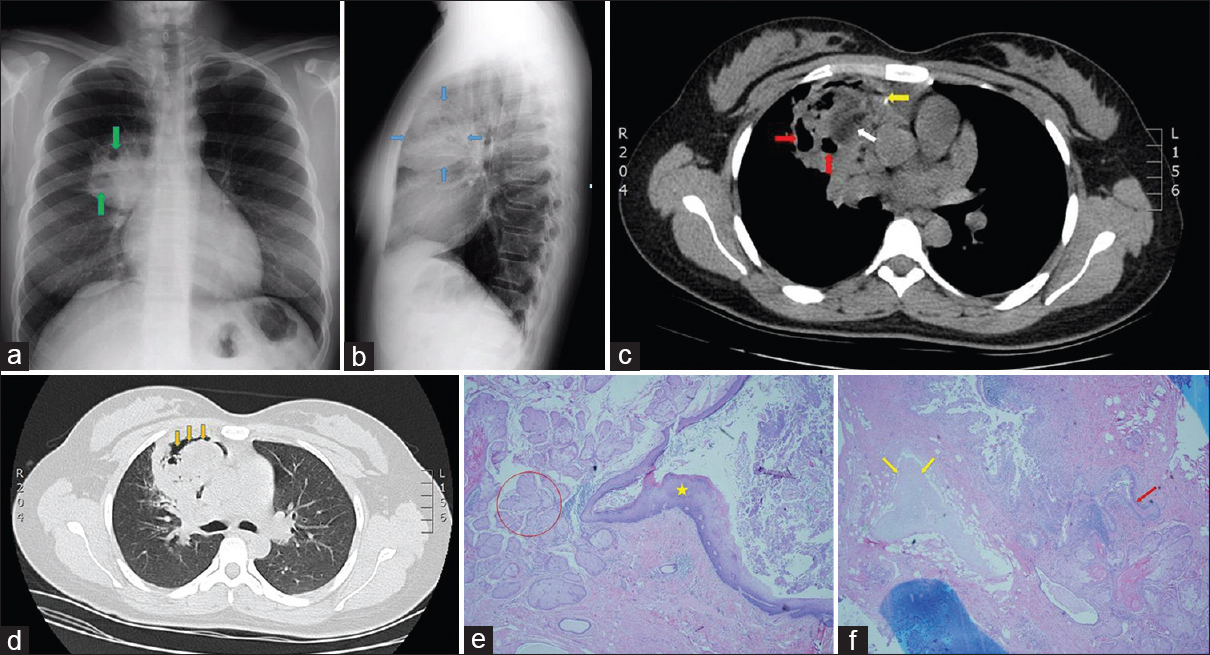 A 27-year-old woman from Ecuador presenting with chronic productive cough. (a) Posteroanterior chest radiograph shows a large right upper lobe mass with internal lucencies (green arrows). (b) Lateral projection of the chest radiograph localizes the mass to the anterior segment of the right upper lobe (blue arrows). (c) Axial chest computed tomography image without intravenous contrast shows a heterogeneous mass in the anterior right upper lobe containing cystic lucencies (red arrows) and a punctate calcification (yellow arrow). Likewise present is an area of low attenuation measuring fat density (white arrow). (d) Lung window chest computed tomography image depicts an air crescent within the mass (orange arrows). (e) Section from surgical specimen contains ectodermal elements: epidermis (asterisk), and sebaceous glands (red circle); (H and E, ×200). (f) Different area of the mass contains cartilage (yellow arrows) and bronchial epithelium (red arrow), which are derived from mesoderm and endoderm, respectively (H and E, ×200).