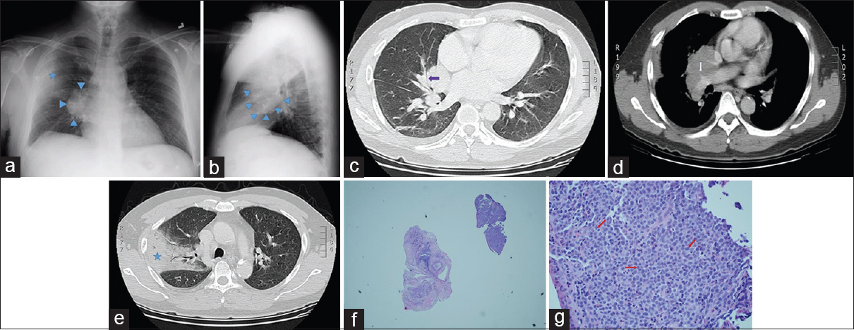 A 50-year-old Malaysian man presenting with fever, chest pain, and hemoptysis. (a) Posteroanterior plain chest radiograph shows a right hilar mass (blue arrowheads) with an ipsilateral alveolar opacity in the lung periphery (blue star). (b) Lateral plain chest radiograph demonstrates the right hilar mass in a different projection (blue arrowheads). (c) Axial chest computed tomography image with lung windows shows a right hilar mass narrowing the right middle lobe medial segment bronchus (purple arrow). (d) Contrast-enhanced chest computed tomography image demonstrates the right hilar mass encasing the right upper lobe branch of the right pulmonary artery (white arrow). (e) Chest computed tomography image with lung windows shows a right upper lobe posterior segment consolidation clinically presumed to represent postobstructive pneumonia (blue star). (f) Very low-power view of the endobronchial biopsy specimen shows a fragment of tissue (upper right) with a cellular infiltrate and a fragment of benign airway cartilage (center) for comparison. (g) Higher magnification of the diagnostic sample reveals monotonous lymphoid-like cells (red arrows) lacking cohesion and exhibiting a high nuclear: cytoplasmic ratio and prominent nucleoli, a pattern consistent with lymphoma. Immunohistochemical staining established the B-lymphocyte as the neoplastic cell in this tumor (H and E, ×400).