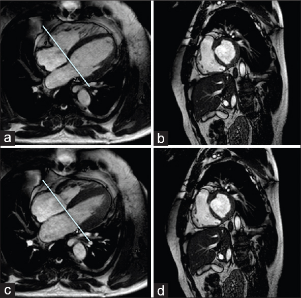 Limitations of the short-axis orientation for right ventricular functional analysis. Short axis (b and d) and horizontal long axis (a and c) balanced steady-state free precession cardiac magnetic resonance images of the heart: diastole (a and b) and systole (c and d). The straight line on the horizontal long axis images (a and c) depicts the location of the corresponding basilar short-axis image in diastole (c) and at the same location with the ventricle in systole (d). Example illustrates the apical displacement of the tricuspid valve plane with systole (d) and the thin wall of the right ventricle that can be difficult to distinguish from the right atrium on the short-axis orientation (b and d).