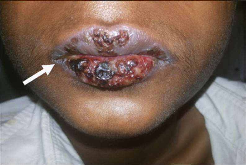 15-year-old male presented with oral mucosal lesions with encrustation and blisters and abdominal pain diagnosed as due to Castleman's disease. Photograph shows the oral lesions.