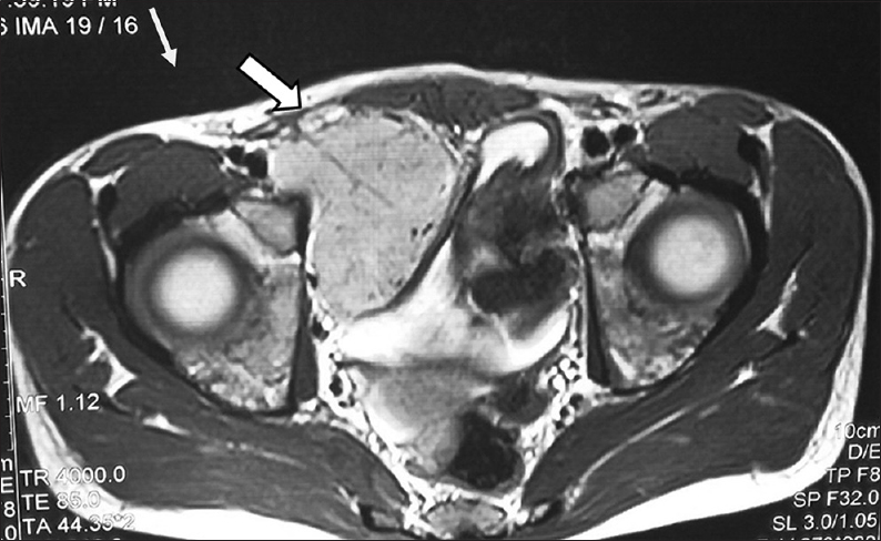 15-year-old male child presented with oral ulcers and abdominal pain diagnosed as due to Castleman's disease. Magnetic resonance imaging of the abdomen, axial image shows homogeneous mass 6 cm × 5 cm (arrow) arising from right hemipelvis.