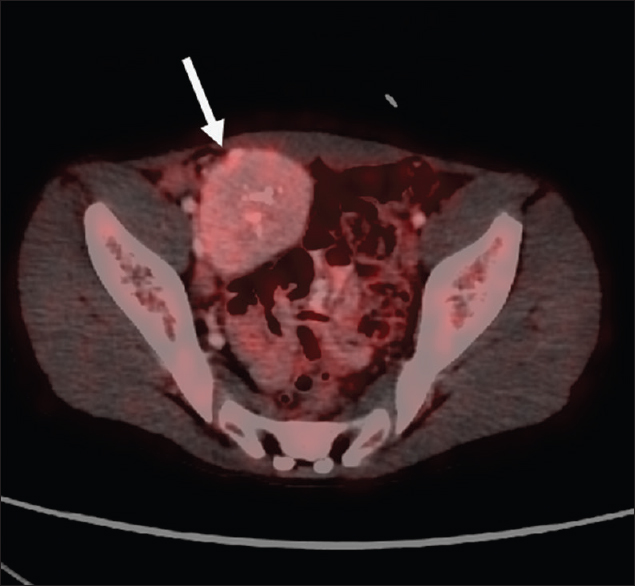 A 15-year-old male child presented with oral ulcers and abdominal pain diagnosed as Castleman's disease with fluorodeoxyglucose positron emission tomography axial image showing faintly fluorodeoxyglucose avid soft tissue mass in the right hemipelvis (arrow).