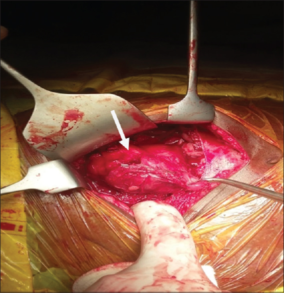 15-year-old male child presented with oral ulcers and abdominal pain diagnosed as due to Castleman's disease., Intraoperative image shows the mass during dissection.