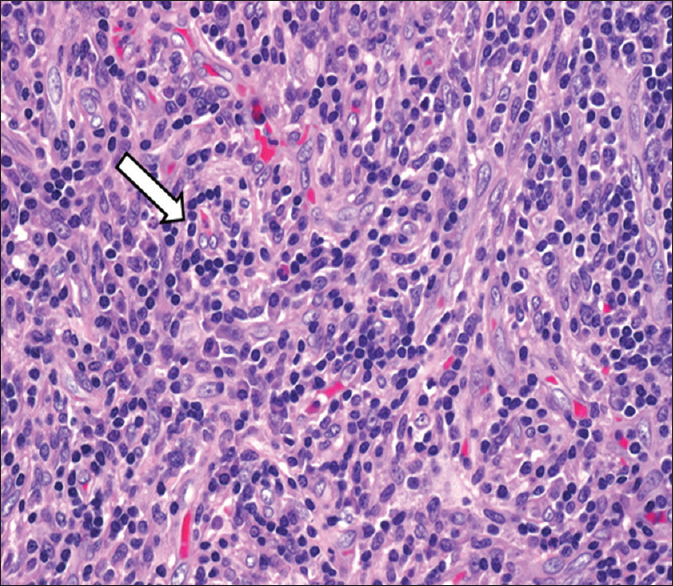 15-year-old male child presented with oral ulcers and abdominal pain diagnosed as due to Castleman's disease. Hematoxylin and eosin stained biopsy tissue (×10 magnification) of the oral mucosal lesion shows dense lymphocytic infiltrates (arrow) with capillaries around them. Direct immunofluorescence revealed intraepidermal intercellular staining with immunoglobulin G (not uploaded).