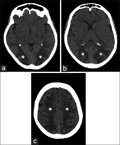 65-year-old Italian woman, after chemotherapy (Escherichia coli L-asparaginase, daunorubicin, vincristine, intrathecal methotrexate) for a B-acute lymphoblastic leukemia, developed a comatose state. Brain axial computed tomography scan at the level of (a) occipital lobe, (b) parietal lobe and (c) centrum semiovale of frontal lobes showed subcortical white matter hypodensity (*).