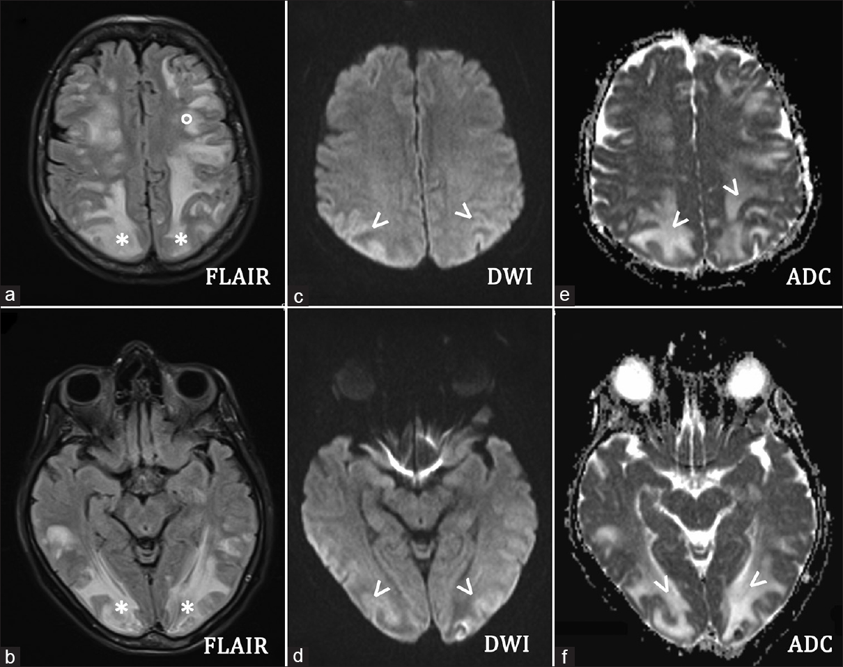 65-year-old Italian woman, after chemotherapy (Escherichia coli L-asparaginase, daunorubicin, vincristine, intrathecal methotrexate) for a B-acute lymphoblastic leukemia, developed a comatose state Brain axial magnetic resonance imaging (a and b) fluid-attenuated inversion recovery sequences showed increased signals in the subcortical occipital (*) and frontal (°) white matter. Brain axial (c and d) diffusion weighted imaging revealed light hyperintensity of the affected areas (arrows) with an increased apparent diffusion coefficient value (arrows) (e and f), indicating vasogenic edema. Diffusion-weighted imaging should always be combined with the study of the apparent diffusion coefficient map that allows us to differentiate the vasogenic oedema (increased signal in apparent diffusion coefficient, i.e., posterior reversible encephalopathy syndrome, as in the present case) from the cytotoxic edema (decreased signal in apparent diffusion coefficient, i.e., ischemic lesion).