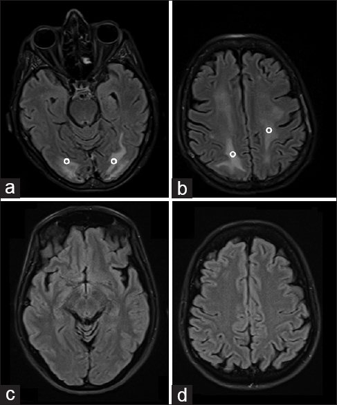 65-year-old Italian woman, after chemotherapy (Escherichia coli L-asparaginase, daunorubicin, vincristine, intrathecal methotrexate) for a B-acute lymphoblastic leukemia, developed a comatose state Brain axial magnetic resonance imaging fluid-attenuated inversion recovery sequences performed 14 days later showed persistently increased signals (°) in the subcortical occipital (a) and frontal (b) white matter, that disappeared 1 month later (c and d).