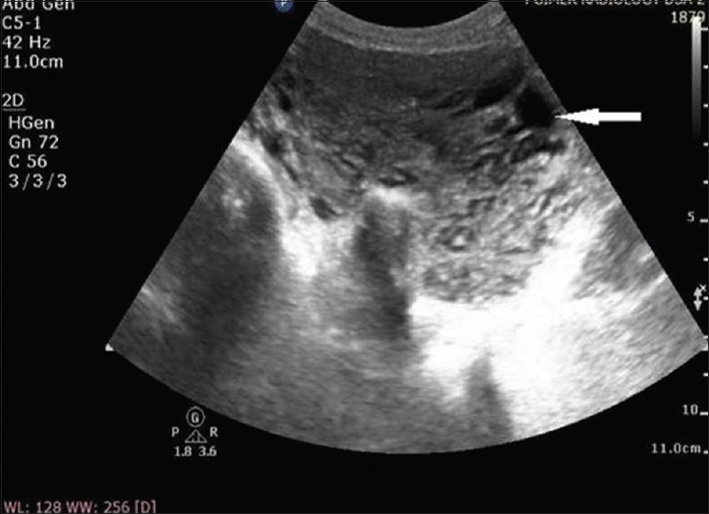 A 25-year-old female with uterine arteriovenous malformation who presented with postcoital vaginal bleeding. Transabdominal gray-scale ultrasound image of uterus showing myometrial heterogeneity with multiple anechoic cystic structures (arrow).