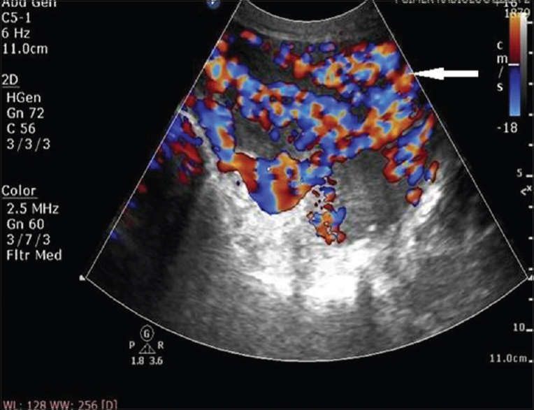 A 25-year-old female with uterine arteriovenous malformation who presented with postcoital vaginal bleeding. Doppler ultrasound image of uterus shows typical mosaic pattern signals (arrow) with the spectral analysis revealing a high-velocity flow with low-resistance index suggesting arteriovenous malformation