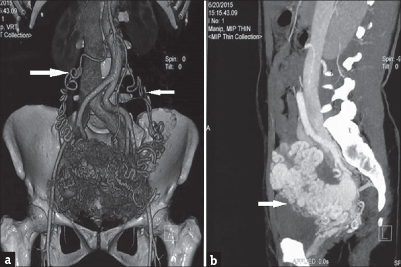 (a) Contrast-enhanced computed tomography scan of pelvic cavity in a woman with uterine arteriovenous malformation. The coronal volume rendered image shows multiple serpiginous vascular channels in the uterus and parametrium with multiple feeders from bilateral gonadal arteries (arrow) and internal iliac arteries suggesting arteriovenous malformation. (b) Contrast-enhanced computed tomography scan of pelvic cavity in a woman with uterine arteriovenous malformation. The sagittal maximum intensity projection shows multiple serpiginous enhancing vascular channels (arrow) within the myometrium and parametrium suggesting arteriovenous malformations.