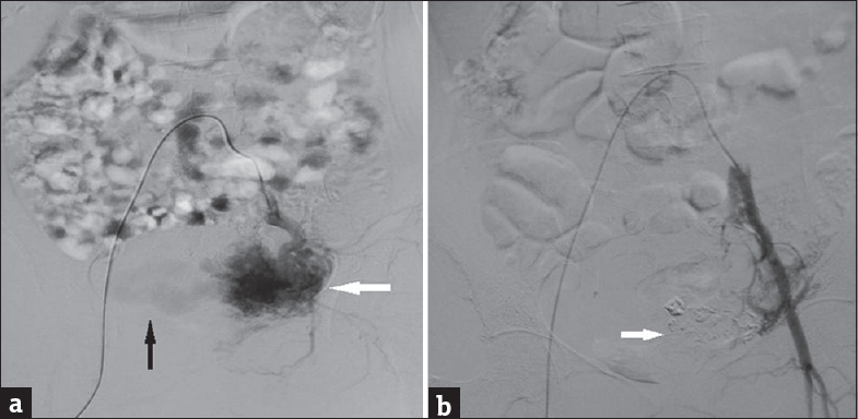 (a) Digital subtraction angiography image of uterus in a woman with uterine arteriovenous malformation. Preembolization image with selective catheterization of the left internal iliac artery and run shows contrast blush (white arrow) within arteriovenous malformation and early draining veins (black arrow) suggesting abnormal communicating blood vessels. (b) Digital subtraction angiography image of uterus in a woman with uterine arteriovenous malformation. This post embolization image with run shows glue cast (arrow) and no contrast blush suggesting sealing arteriovenous malformation by glue.