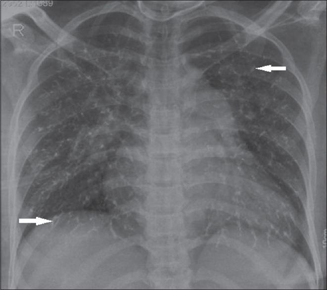 Chest X-ray (posteroanterior view) of a woman with uterine arteriovenous malformation. She had undergone glue embolization and developed shortness of breath immediately after the procedure. Chest X-ray shows multiple branching patterns of linear radio densities (arrow) scattered in the bilateral lungs and prominent pulmonary bay suggesting glue embolization.