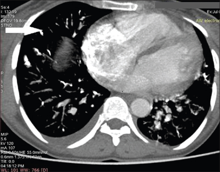 Contrast-enhanced computed tomography scan of chest in a woman with uterine arteriovenous malformation and glue embolization. The axial image of computed tomography chest shows the presence of linear hyperdensities within the segmental branches of bilateral pulmonary artery (arrow) suggesting glue embolization in the pulmonary artery.