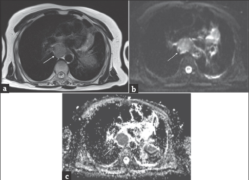 A 76-year-old woman with known lung carcinoma. Magnetic resonance imaging of the mediastinum. (a) Axial T2-weighted image shows an enlarged subcarinal lymphadenopathy (arrow). (b) On axial diffusion-weighted magnetic resonance image at b = 600 s/mm2, the lymphadenopathy is hyperintense (arrow). (c) Region of interest was placed on hypointense lymphadenopathy (arrow) with an apparent diffusion coefficient value = 0.97 ± 0.23 × 10−3 mm2/s.