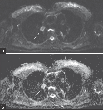 A 48-year-old woman with known sarcoidosis. Magnetic resonance imaging of the mediastinum. (a) On axial diffusion-weighted magnetic resonance image at b = 600 s/mm2, the lymphadenopathy is hypointense (arrow). (b) The region of interest was placed on slightly hyperintense lymphadenopathy (arrow) with an apparent diffusion coefficient value = 1.63 ± 0.1 × 10−3 mm2/s.