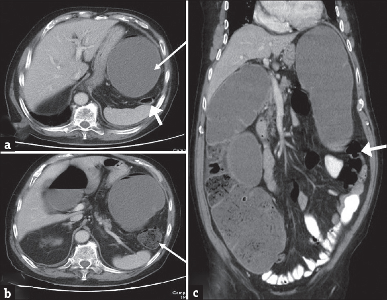 Colorectal cancer: (a and b) Axial contrast-enhanced computed tomography images in a 60-year-old male patient with colorectal cancer presenting with weight loss and chronic abdominal pain demonstrate marked distension of transverse colon and splenic flexure (long arrow in a) with associated short segment mural thickening of proximal descending colon with abrupt transition (short arrow) to a normal appearing descending colon (long arrow in b). The large bowel dilatation and abrupt transition are better depicted on the coronal image (c).