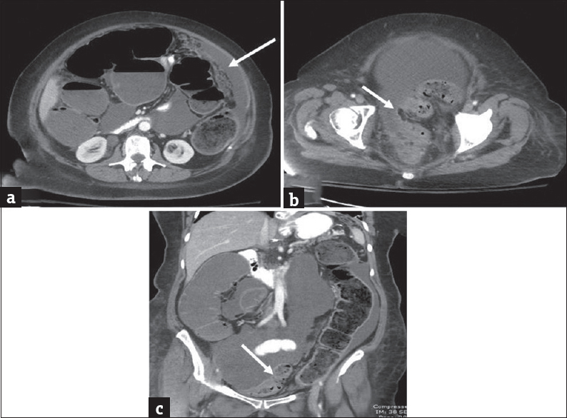 Extra colonic malignancies: (a and b) Axial contrast-enhanced computed tomography images in a 56-year-old female patient with history of ovarian cancer presenting with abdominal distension demonstrate ascites, peritoneal thickening and omental caking consistent with peritoneal carcinomatosis (arrow in a). There is marked distension of the proximal large bowel and fecal loading of the descending colon. The pelvic peritoneal metastatic deposits caused extrinsic narrowing of the sigmoid colon (arrow in b) and accounted for the large bowel obstruction. The large bowel dilatation and transition point in the sigmoid colon are better depicted on the coronal image (c).