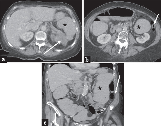 Extracolonic malignancy: Axial (a and b) and coronal (c) contrast-enhanced computed tomography images in a 73-year-old man presenting with weight loss and worsening left upper quadrant abdominal pain demonstrate a heterogeneous mass arising from the pancreatic tail which is contiguously infiltrating the splenic flexure of colon (arrow in a). There is marked distension of ascending and transverse colon and splenic flexure (asterisk) with decompressed descending colon (arrows in b and c). The large bowel obstruction resulted from contiguous infiltration of the splenic flexure from pancreatic tail cancer.