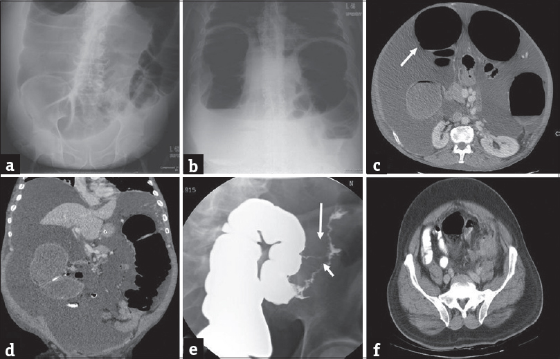 Large bowel obstruction secondary to diverticular stricture. Plain radiographs of the abdomen, supine and erect views (a and b) in a 45-year-old man presenting to the emergency department with severe abdominal pain and lack of bowel movements demonstrate markedly dilated loops of large bowel compatible with large bowel obstruction. Axial (c) and coronal (d) contrast-enhanced computed tomography images demonstrate dilated large bowel loops (arrow in c) with associated concentric thickening and stricture (arrow in d) of the distal descending colon without discrete mass. Single column barium enema (e) performed subsequently better demonstrates the stricture (short arrow) and an additional fistula (long arrow). Axial computed tomography image (f) performed an year earlier demonstrates changes of acute diverticulitis which eventually led to stricture and large bowel obstruction.