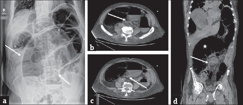 Sigmoid volvulus: (a) Erect plain abdominal radiograph in a 58-year-old man presenting with abdominal distension and severe lower abdominal pain demonstrates marked distension of the sigmoid colon with a typical coffee-bean sign (arrows) which is highly characteristic of sigmoid volvulus. A rubber tube has been placed for decompression. Axial contrast-enhanced computed tomography images (b and c) in another patient with similar presentation demonstrates the whirl pattern (arrow in b) and the characteristic bird beak appearance (arrow in c). The redundant and dilated sigmoid colon (asterisk) is better depicted on the coronal image (d) with characteristic beak appearance (arrow).