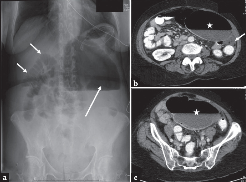 Cecal volvulus: (a) Erect plain radiograph of the abdomen in a 65-year-old male patient presenting with severe abdominal pain demonstrates mildly dilated loops of small bowel (short arrows) in the right hemi abdomen and a markedly dilated gas filled structure in the left upper quadrant (long arrow) which is compressing the stomach which contains nasogastric tube. Axial contrast enhanced computed tomography images (b and c) demonstrate a large air and fluid filled structure in the left abdomen (asterisk) with absence of cecum in its normal location. A small amount of fluid (arrow) is noted secondary to early ischemia. The enteric contrast is noted to opacify only the small bowel. Imaging findings are concerning for cecal volvulus which was subsequently confirmed at surgery.