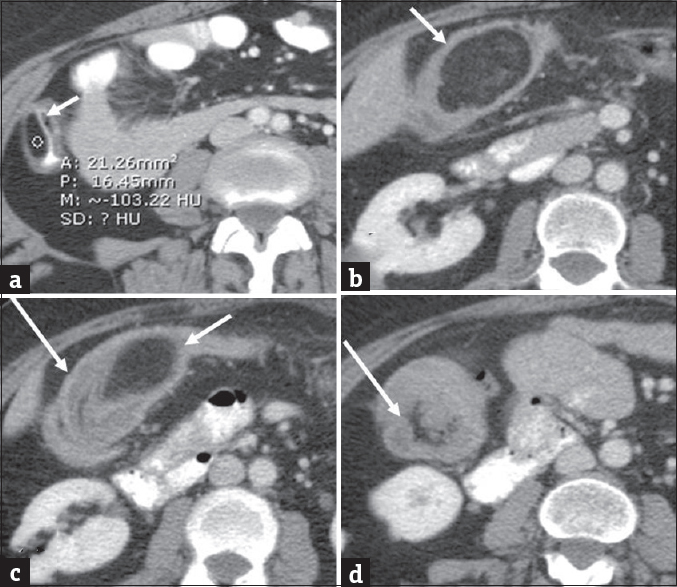 Colonic lipoma complicated by intussusception. Colonic lipoma complicated by intussusception. Axial (a) contrast-enhanced computed tomography in a 40-year-old man demonstrates small colonic lipoma (arrow). Follow-up computed tomography 5 years later when the patient presented clinically with symptoms of abdominal pain and subacute intestinal obstruction. Axial (b-d) contrast-enhanced computed tomography images demonstrate interval significant growth of the lipoma (short arrows) with associated colonic intussusception (long arrows).