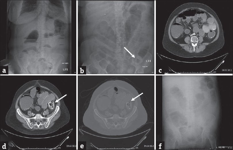 Enterolith: (a and b) Erect and supine plain abdominal radiograph in a 56-year-old man presenting with abdominal distension, vomiting, and severe lower abdominal pain demonstrates dilatation of the small and large bowel loops with associated air-fluid levels concerning for obstruction. A lamellated calcific shadow (arrow) is noted in the left lower quadrant. Computed tomography scan (c-e) performed subsequently confirms an enterolith (arrows) in the distal descending colon which resulted in bowel obstruction. No mass was identified and the patient was managed conservatively with endoscopic fragmentation and removal of the enterolith. Plain abdominal radiograph performed subsequently demonstrated complete removal of the enterolith and interval improvement of bowel obstruction (f).