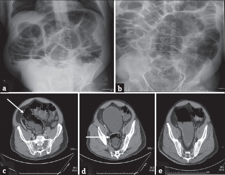 Fecal impaction: (a and b) Erect and supine plain abdominal radiograph in a 75-year-old man presenting with abdominal distension and worsening lower abdominal pain demonstrates dilatation of the large bowel loops. Computed tomography scan (c and d) performed subsequently demonstrates large amount of stool in the sigmoid colon and rectum (arrows) which resulted in large bowel dilatation. No mass was identified and the patient was managed conservatively with enemas. Repeat computed tomography performed subsequently demonstrates resolution of the impacted feces with residual fluid in the sigmoid colon (e).