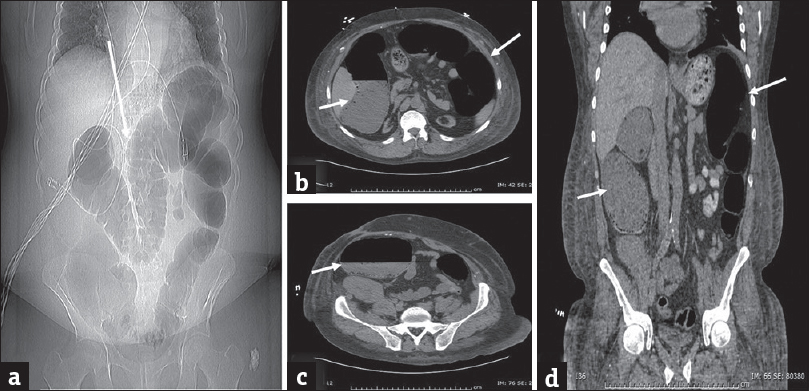 Ogilvie's syndrome: (a) Plain abdominal radiograph in a 61-year-old man presenting with abdominal distension demonstrates marked distension of the colon (arrow). Computed tomography scan (b-d) performed subsequently reveal distended colon (arrows). There is no evidence of small bowel dilatation or obstructing lesion. The patient was managed conservatively.