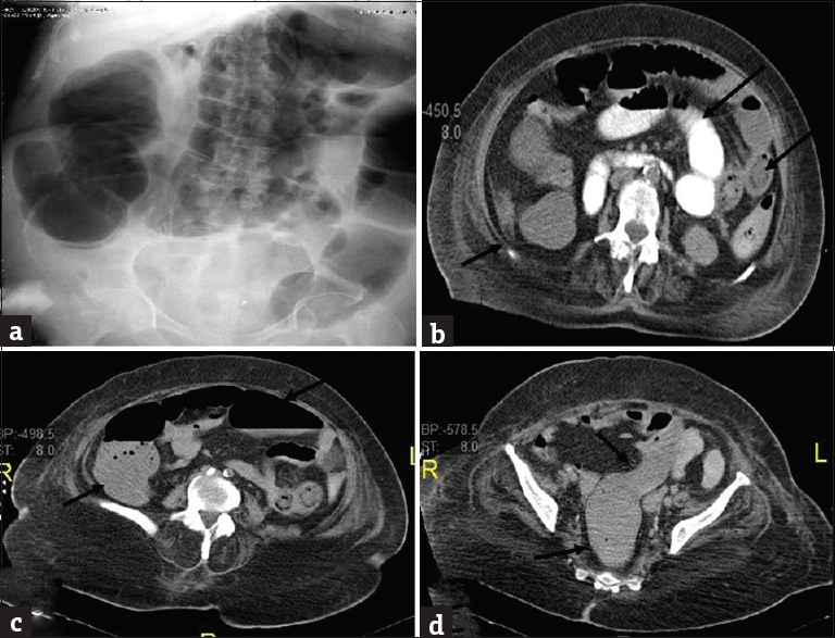 Adynamic ileus in a 65-year-old man with diabetes presenting with diffuse intermittent abdominal pain and found to have sever hypokalemia. (a) Plain abdominal radiograph shows diffuse dilatation of colon. Axial (b-d) contrast-enhanced computed tomography shows diffuse dilatation of both small bowel (long arrows) and colon (short arrows) all the way to rectum without transition.