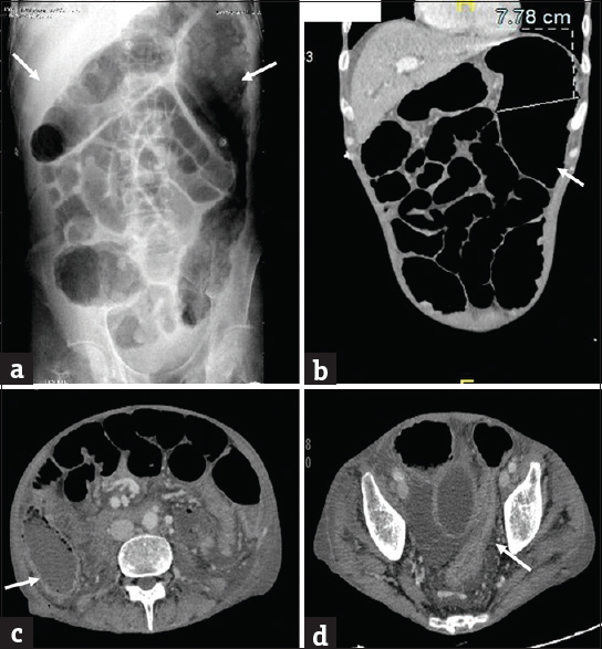 Toxic megacolon in a 55 year old man with known ulcerative colitis. (a) Plain abdominal radiograph shows dilatation of transverse colon and splenic flexure with loss of haustrations. Coronal (b) CT images show the dilatation of splenic flexure with loss of haustrations (arrows). Axial (c and d) CT images demonstrate the changes of acute colitis in the cecum (arrow in c) and rectosigmoid (arrow in d).