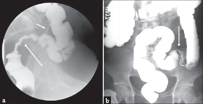 Stricture: (a) Single column barium enema in a 59-year-old man who underwent pelvic irradiation demonstrates a long segment irregular stricture of the rectosigmoid (long arrow). Also noted is a colocolic fistula (short arrow) which is another potential complication of radiation therapy. Barium enema in another patient with history of ischemic colitis demonstrates a short segment smooth stricture (arrow) at the junction of the sigmoid and descending colon (b).