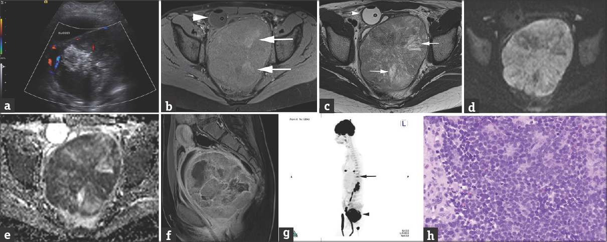 A 12-year-old female presented with acute onset of urinary retention. (a) Transverse, color flow ultrasound image through the pelvis demonstrates a large, heterogeneous mass posterior to the bladder measuring 10.1 cm × 8.8 cm × 12.4 cm (anteroposterior × transverse × craniocaudal), with minimal vascularity, and large hyperechoic foci, some of which shadow, suggestive of calcifications. (b) Axial T1 fat-sat precontrast MRI with a Foley decompressing the bladder (arrowhead) better depicts the large heterogeneous pelvic mass, containing areas of high T1 signal (arrows) corresponding to calcifications present on low-dose noncontrast CT for attenuation correction performed as part of the 18F FDG-PET (not shown). (c) Axial T2 image at a similar level as b shows areas of high T2 signal representing cystic necrosis. (d and e) Axial diffusion and apparent diffusion coefficient map images show extensive restrictive diffusion. (f) Sagittal contrast-enhanced T1 MRI of the pelvis confirms that the large, heterogeneously enhancing mass with areas of necrosis arises from the posterior wall of the vagina, compresses the bladder and the rectum and displaces the uterus superiorly. (g) Sagittal three-dimensional maximum intensity projection 18F FDG-PET/CT demonstrates heterogeneous hypermetabolic uptake in the pelvic mass (arrowhead) as well as additional hypermetabolic foci in the lung bases and at the T11 vertebral body (arrow), consistent with metastatic lesions. (h) Histologic examination shows sheets of small round blue cells with inconspicuous nucleoli (H and E, ×400). The cells are focally arranged in primitive rosettes (top center).