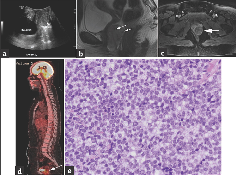 A 15-year-old female presented with progressive abdominal discomfort, profuse menstrual bleeding, and vaginal discharge. (a) Grayscale sagittal ultrasound image through the pelvis obtained at initial presentation demonstrate a slightly heterogeneous, predominantly isoechoic, 3.6 cm × 3.6 cm × 5.9 cm (anteroposterior x transverse x craniocaudal), vaginal mass (arrowhead on a). (b and c) Sagittal T2 (b) and axial postcontrast T1 MRI (c) show the lesion arising from the left vaginal sidewall demonstrating intermediate to high signal on T2-weighted images with few serpentine flow voids (arrows on b) and intermediate to low T1 signal, with heterogeneous contrast enhancement on (c). (d) Sagittal fused 18F FDG-PET/CT demonstrates increased FDG uptake in the mass (arrow) posterior to the bladder. (e) Histologic examination shows sheets of small round blue cells with inconspicuous nucleoli and a suggestion of rosette formation (H and E, ×400 magnification). Pathology image courtesy of Dr. Aashiyana Koreishi, Puget Sound Institute of Pathology - Franciscan Health System.