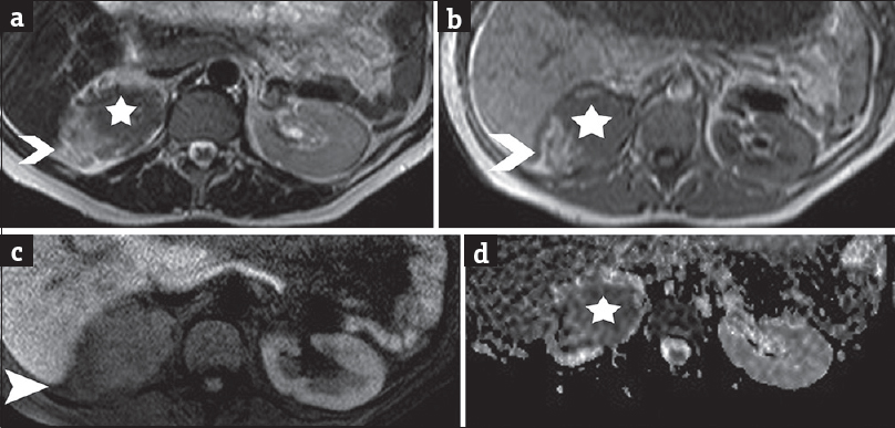 A 41-year-old pregnant woman in the 7th month of pregnancy referred for right-sided abdominal pain and the sonographic diagnosis of polyhydramnios and diagnosed with renal epithelioid angiomyolipoma associated with pulmonary lymphangioleiomyomatosis. (a) Transverse T2-weighted image depicts right renal heterogeneous mass lesion with slightly hyperintense parts (arrowhead), corresponding to areas of fat and solid components (asterisk), of low-signal intensity when compared to normal renal parenchyma. (b) Transverse T1-weighted image shows lesion heterogeneity, with areas of fat detected hyperintense (arrowhead) and solid parts (asterisk), isointense to normal renal medulla. (c) Transverse fat-suppressed T1-weighted image demonstrates saturation of the hyperintense T1 components (arrowhead) of the lesion, findings compatible with the presence of fat. (d) Transverse apparent diffusion coefficient map derived from source image with b value of 700 s/mm2 shows areas of restricted diffusion (asterisk) within the lesion. The apparent diffusion coefficient values were 0.92 × 10−3 mm2 s−1, lower than that of the normal contralateral kidney (2.30 × 10−3 mm2 s−1).