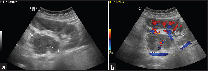 A 41-year-old pregnant woman diagnosed with renal epithelioid angiomyolipoma associated with pulmonary lymphangioleiomyomatosis. (a) Sagittal sonographic image of the right hypochondrium depicts the presence of a heterogeneous, ill-defined mass (cursors) in the interpolar region of the right kidney. The lesion is mainly hypoechoic, extending into the renal sinus. (b) The presence of vascularity is detected within the mass lesion on Doppler examination.