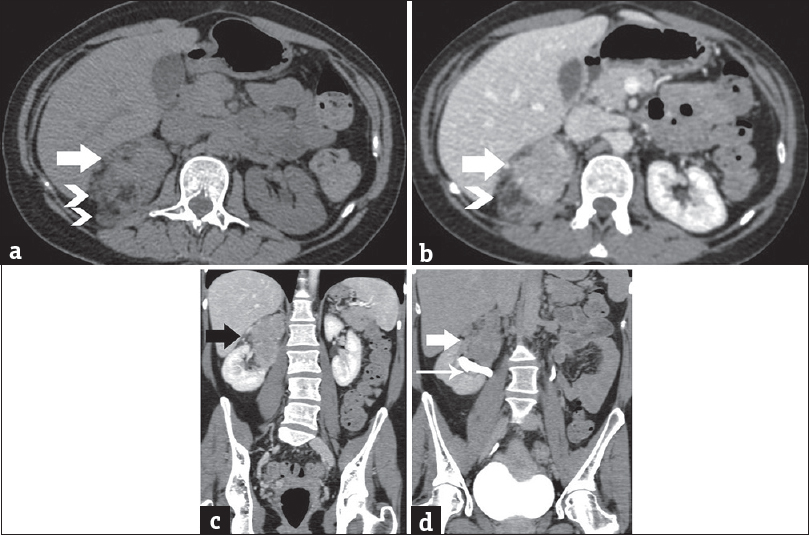 A 41-year-old woman diagnosed with renal epithelioid angiomyolipoma associated with pulmonary lymphangioleiomyomatosis. (a) Transverse unenhanced computed tomography image depicts lesion heterogeneity, with small areas of fat (arrowheads) and solid parts (arrow), slightly hyperdense (mean computed tomography density: 45 HU) relative to the normal renal parenchyma. Contrast-enhanced computed tomography scan, (b) transverse, and (c) coronal reformations during the portal phase depict moderate, heterogeneous lesion enhancement (mean computed tomography density: 95 HU, arrow). Note areas of fat (arrowhead). (d) Contrast-enhanced computed tomography scan, coronal reformation, delayed phase. The mass (arrow) is seen in proximity to the pelvicaliceal system (long arrow), without obvious signs of invasion. No significant wash-out is detected (mean computed tomography density: 65 HU).