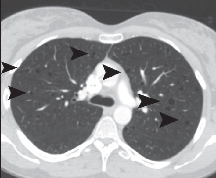 A 41-year-old woman diagnosed with renal epithelioid angiomyolipoma associated with pulmonary lymphangioleiomyomatosis. Transverse chest computed tomography reveals multiple diffuse pulmonary thin-walled cysts (arrowheads).